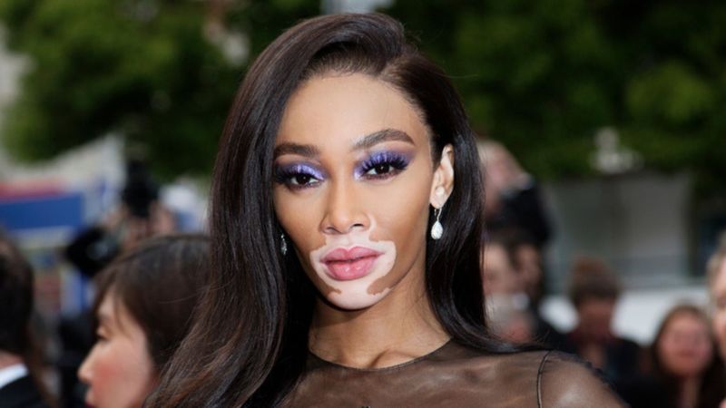 Winnie Harlow: la voz del vitíligo